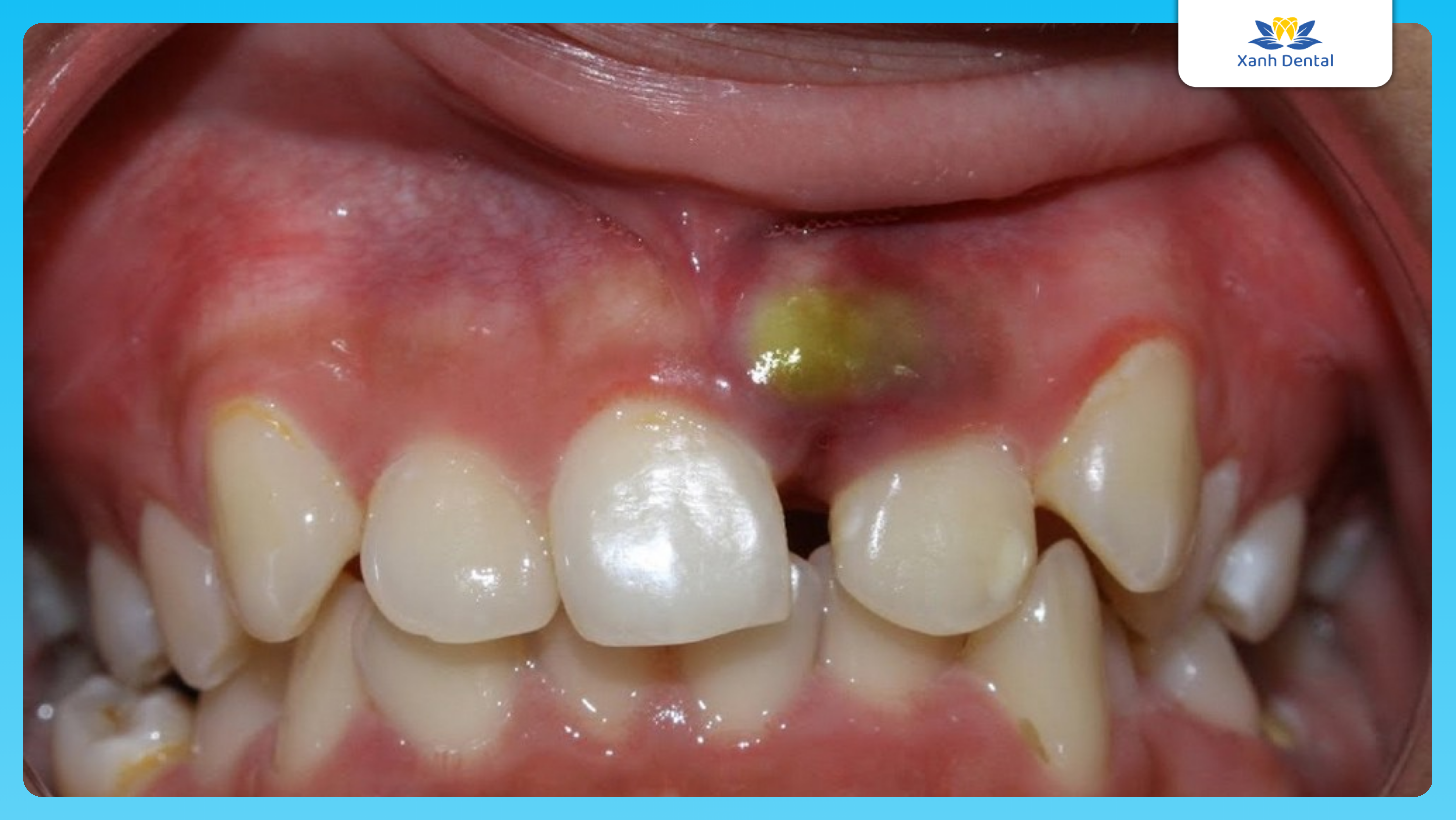 Mức độ sâu răng: Áp-xe răng