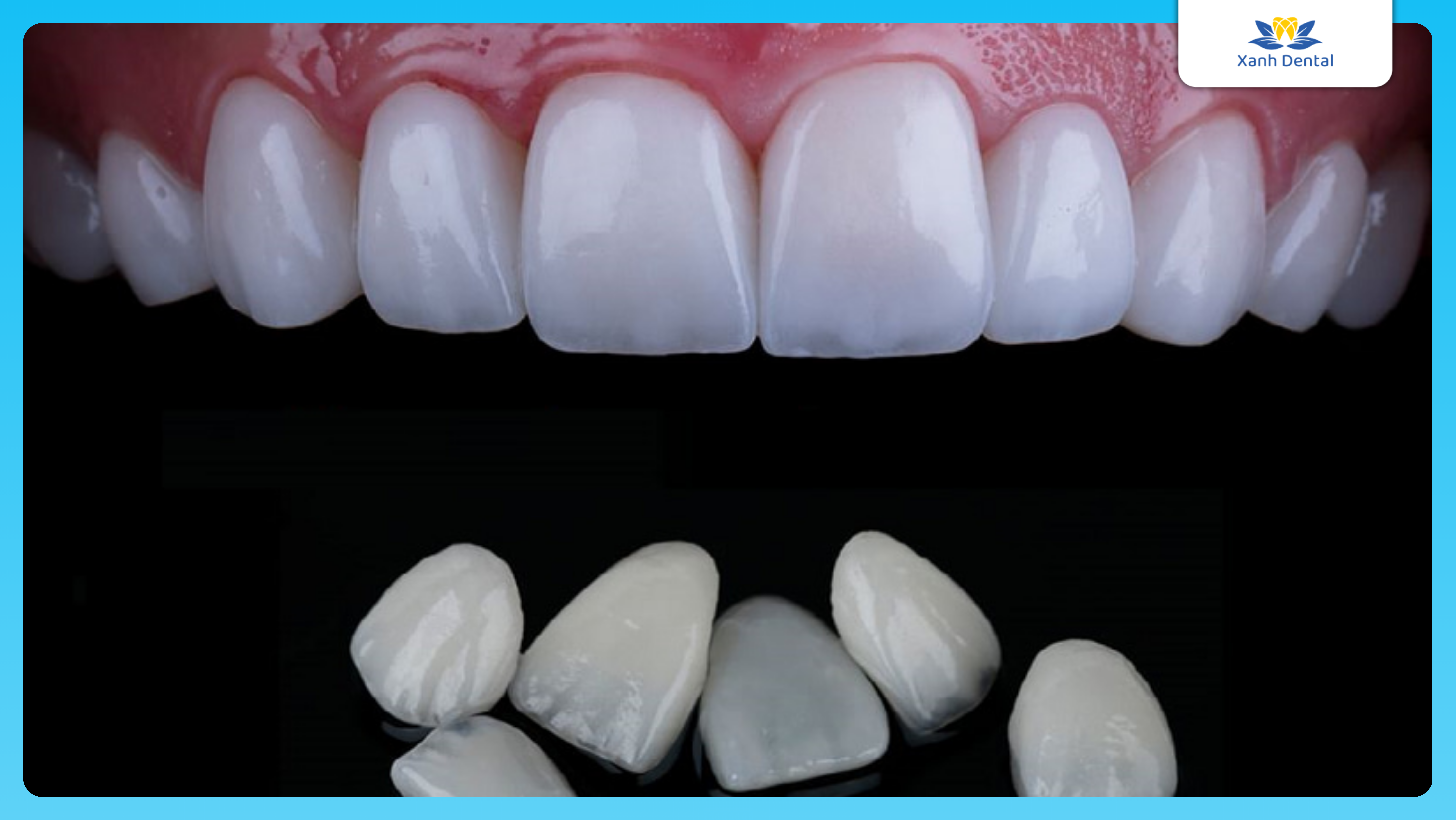 Dán sứ Veneer trong làm răng thỏ