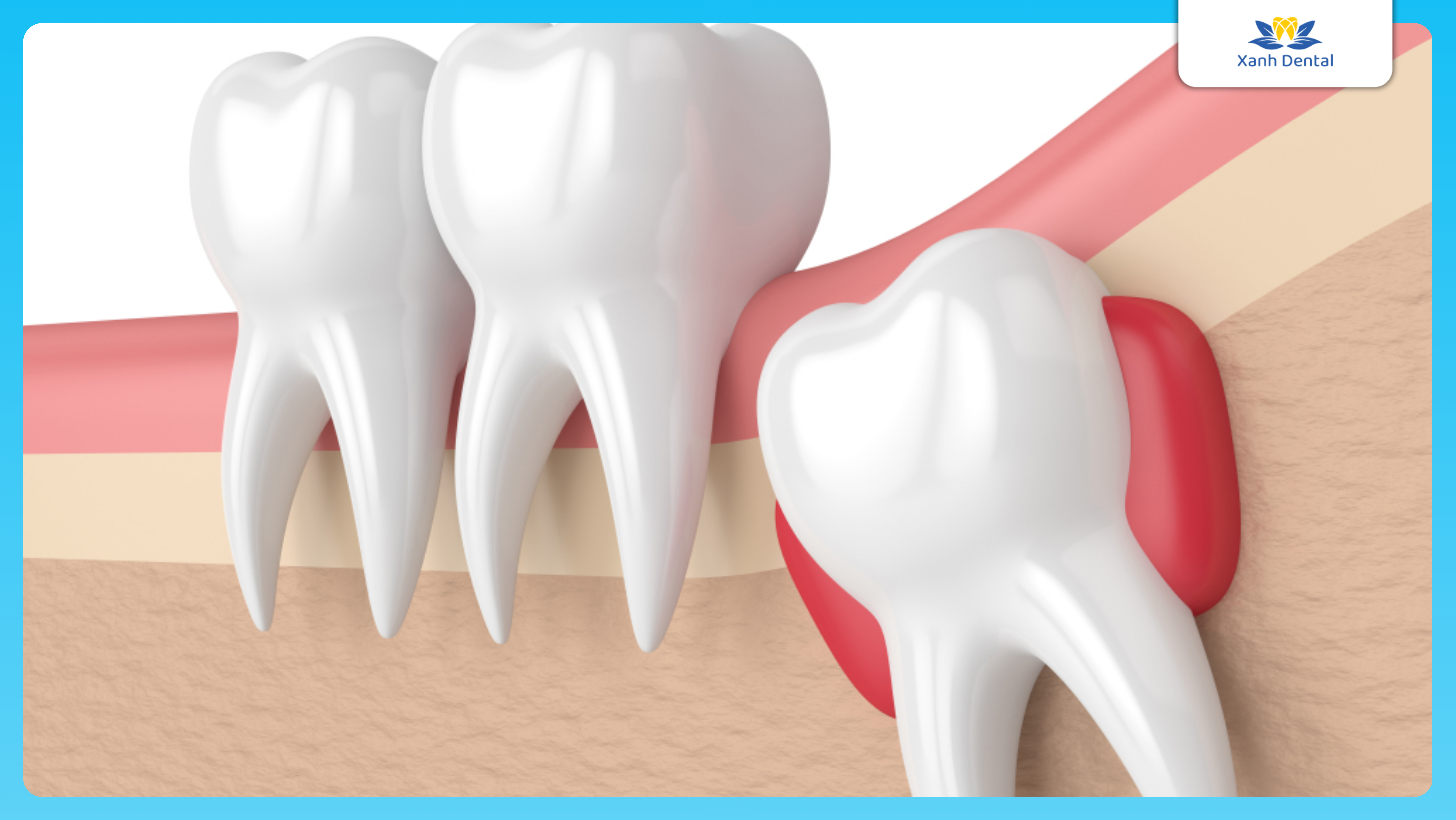 Mọc răng khôn có cần nhổ không?