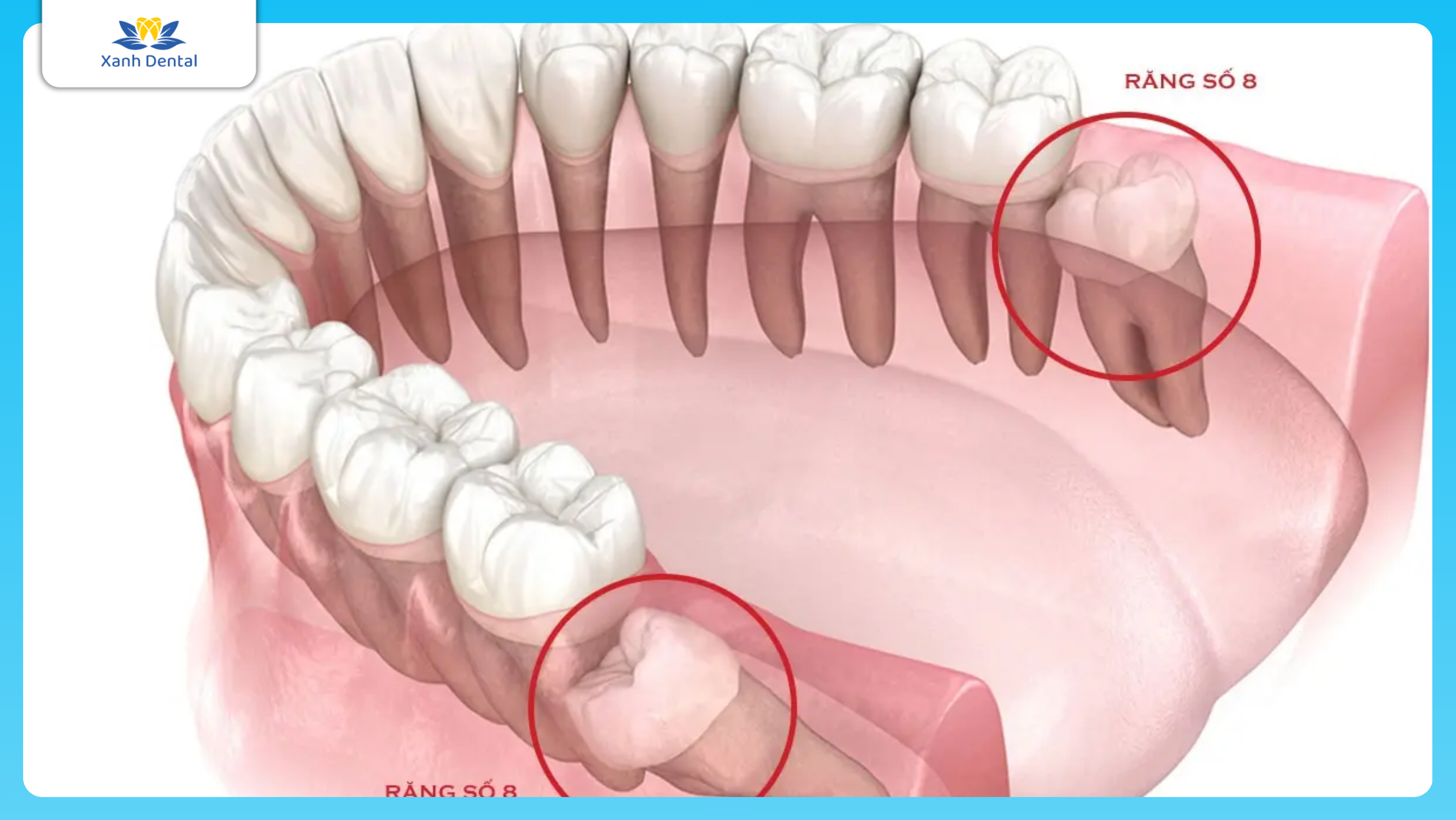 Nhổ răng khôn là gì? Vì sao nhổ răng khôn lại gây tranh cãi