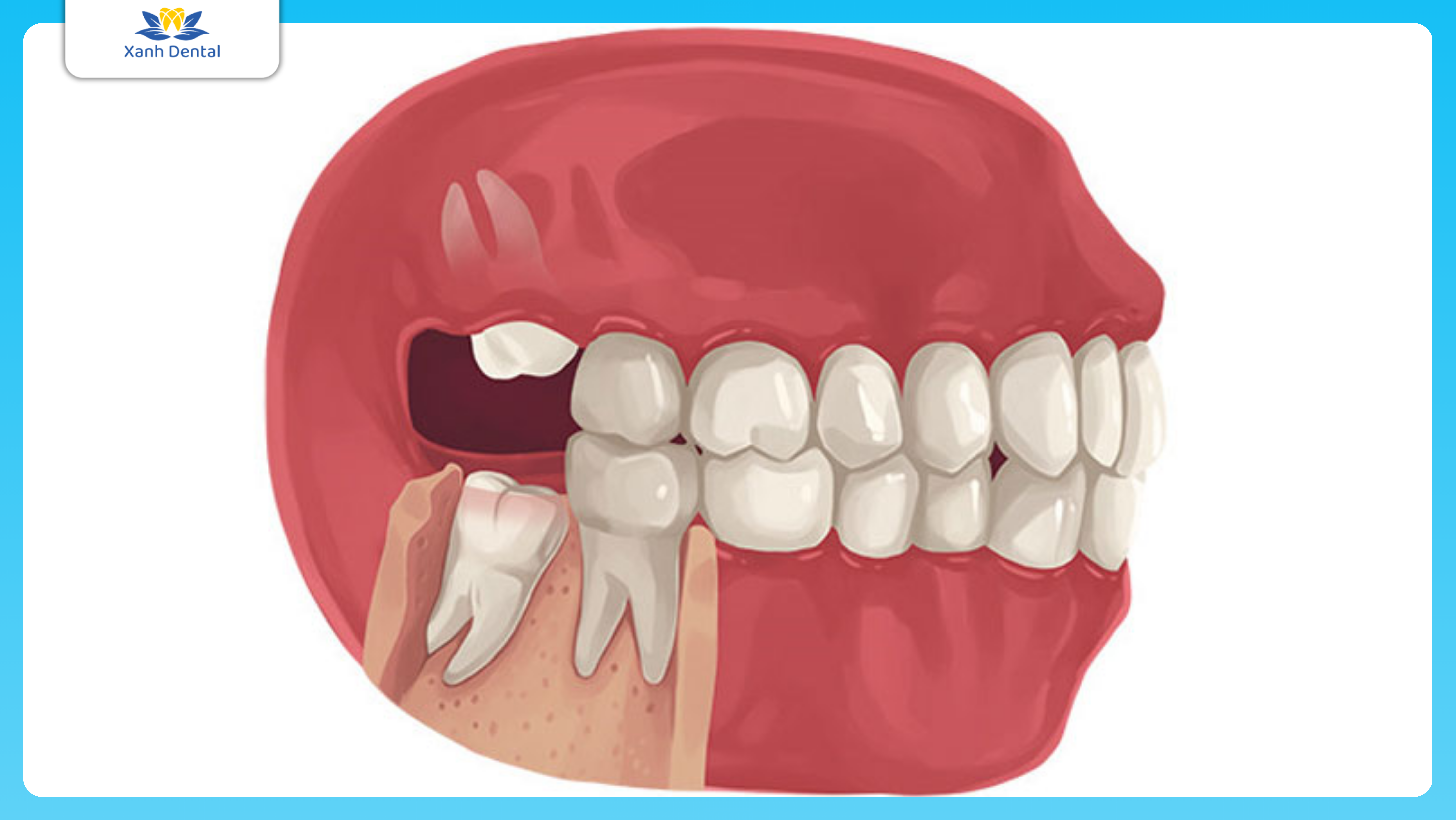 Có phải ai cũng mọc răng khôn?