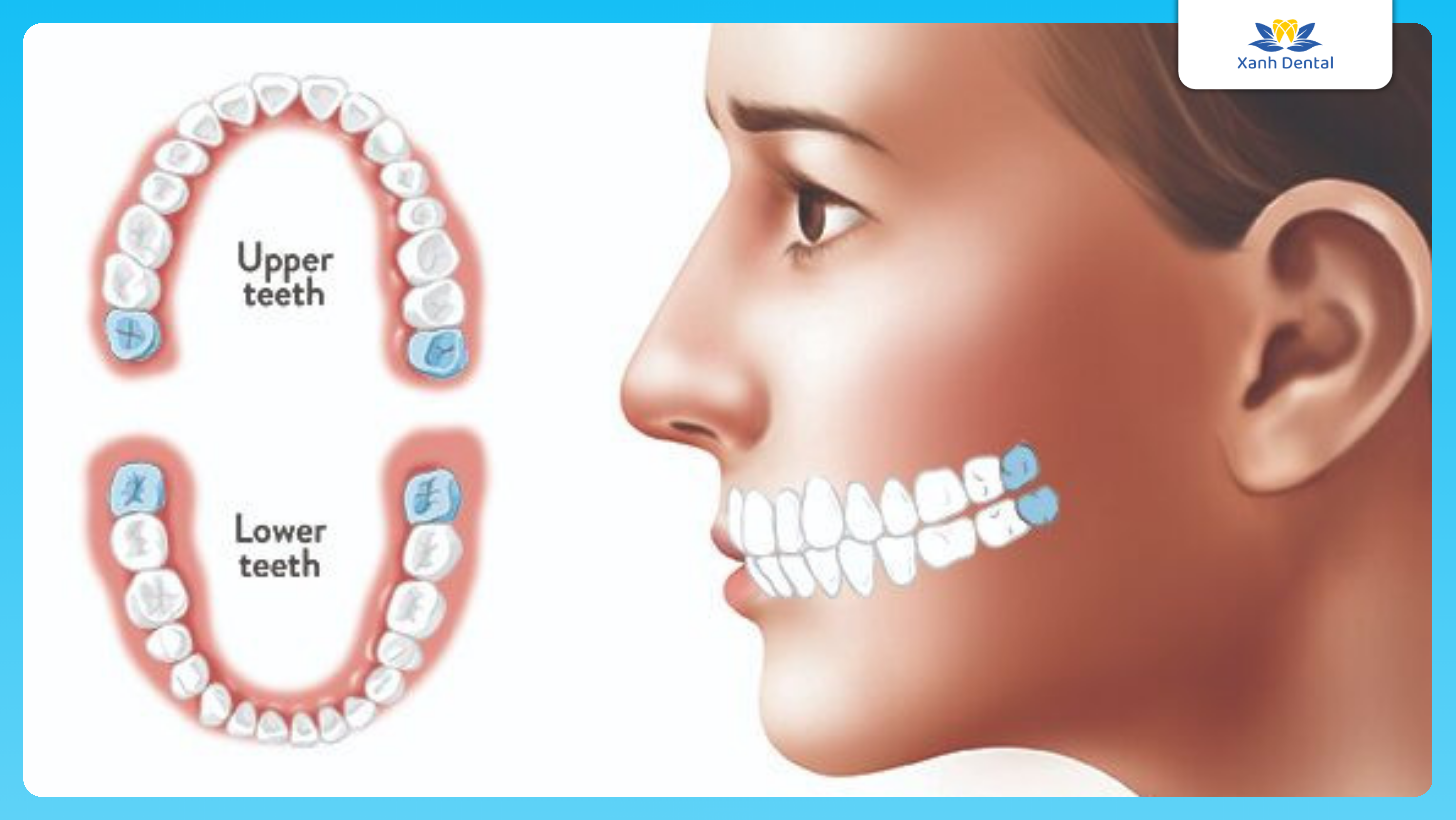 Khi nào nên giữ lại răng khôn?