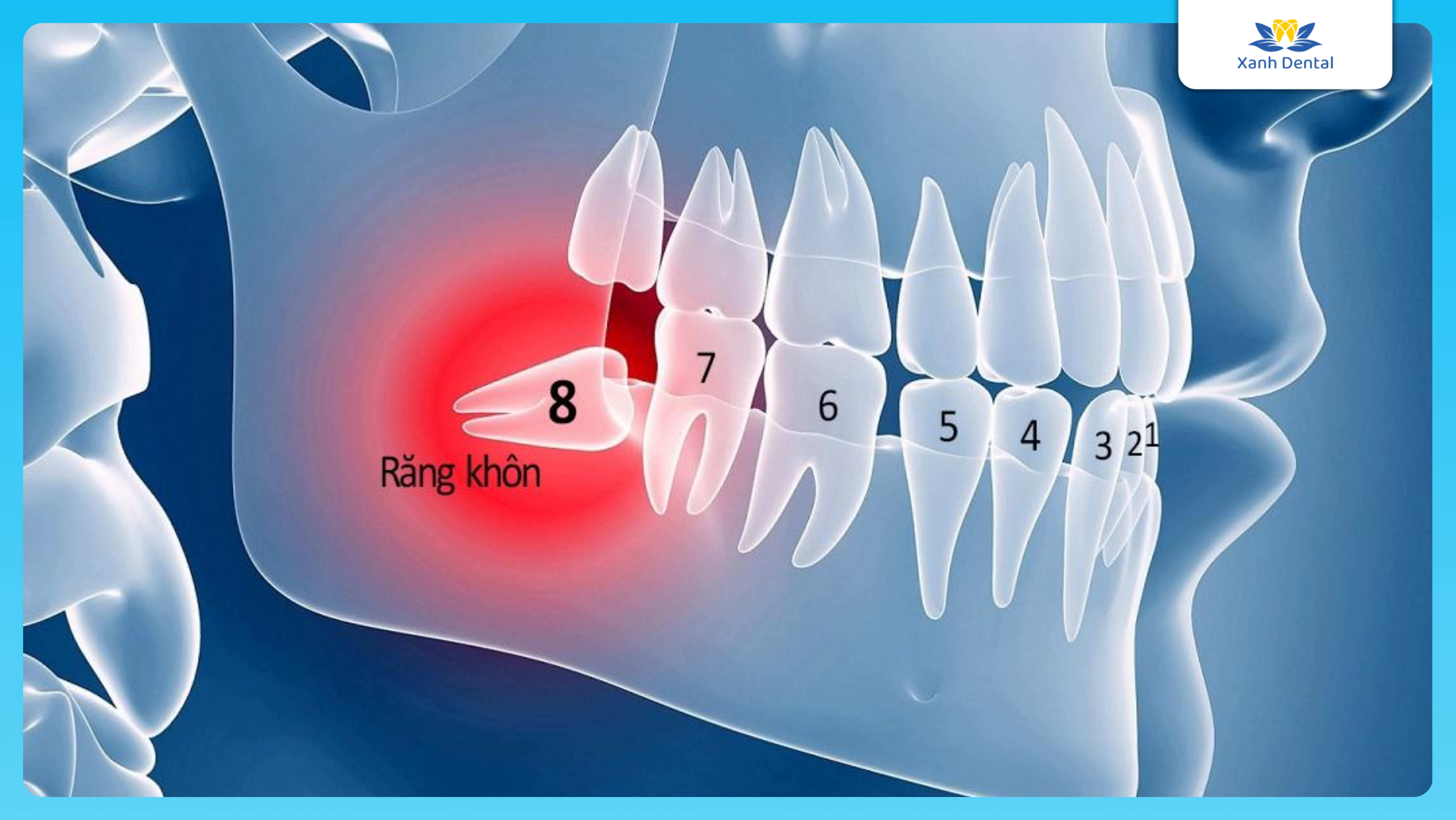 Mỗi người có mấy răng khôn?