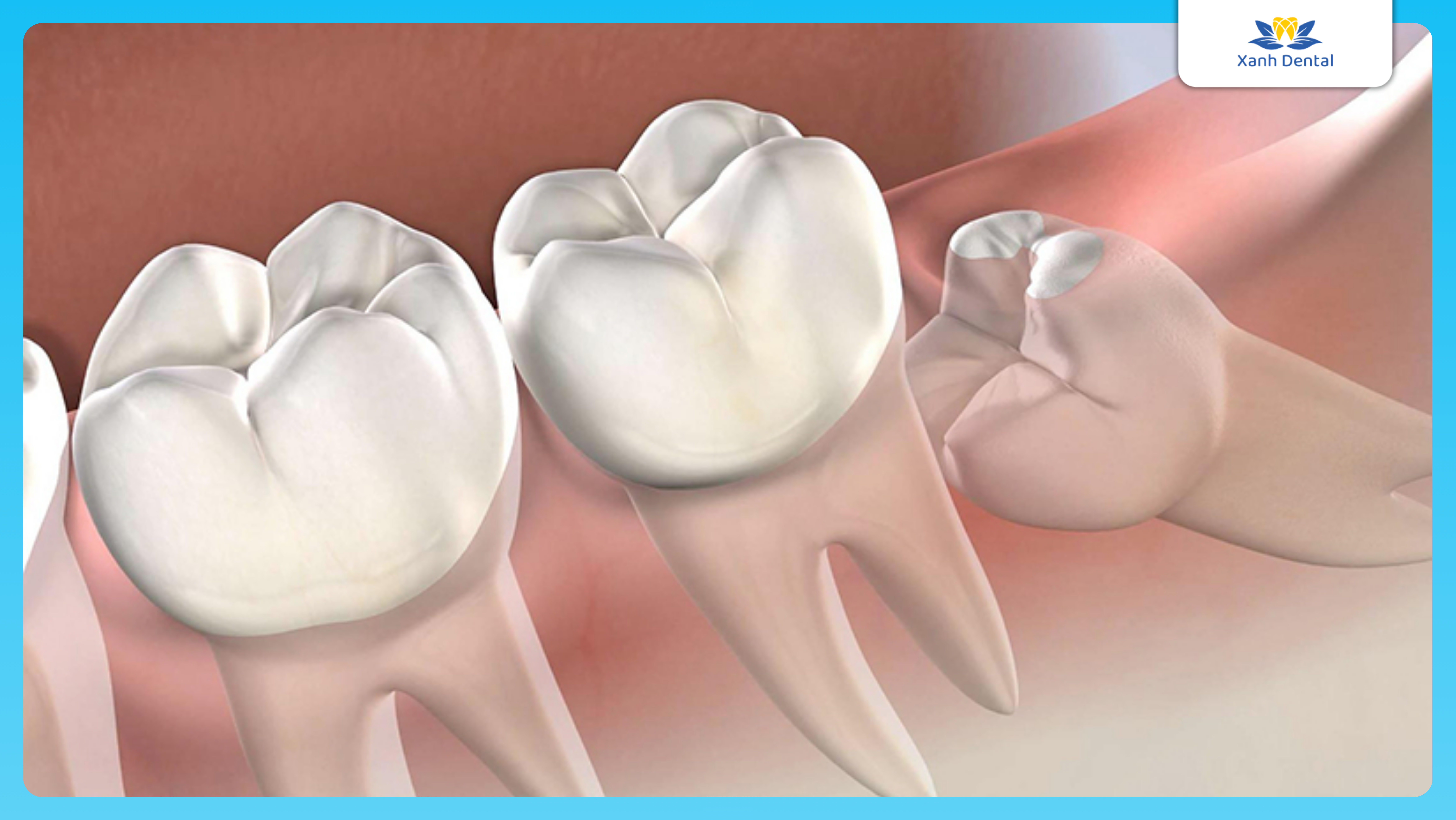 Những dấu hiệu lưu ý khi nhổ răng khôn