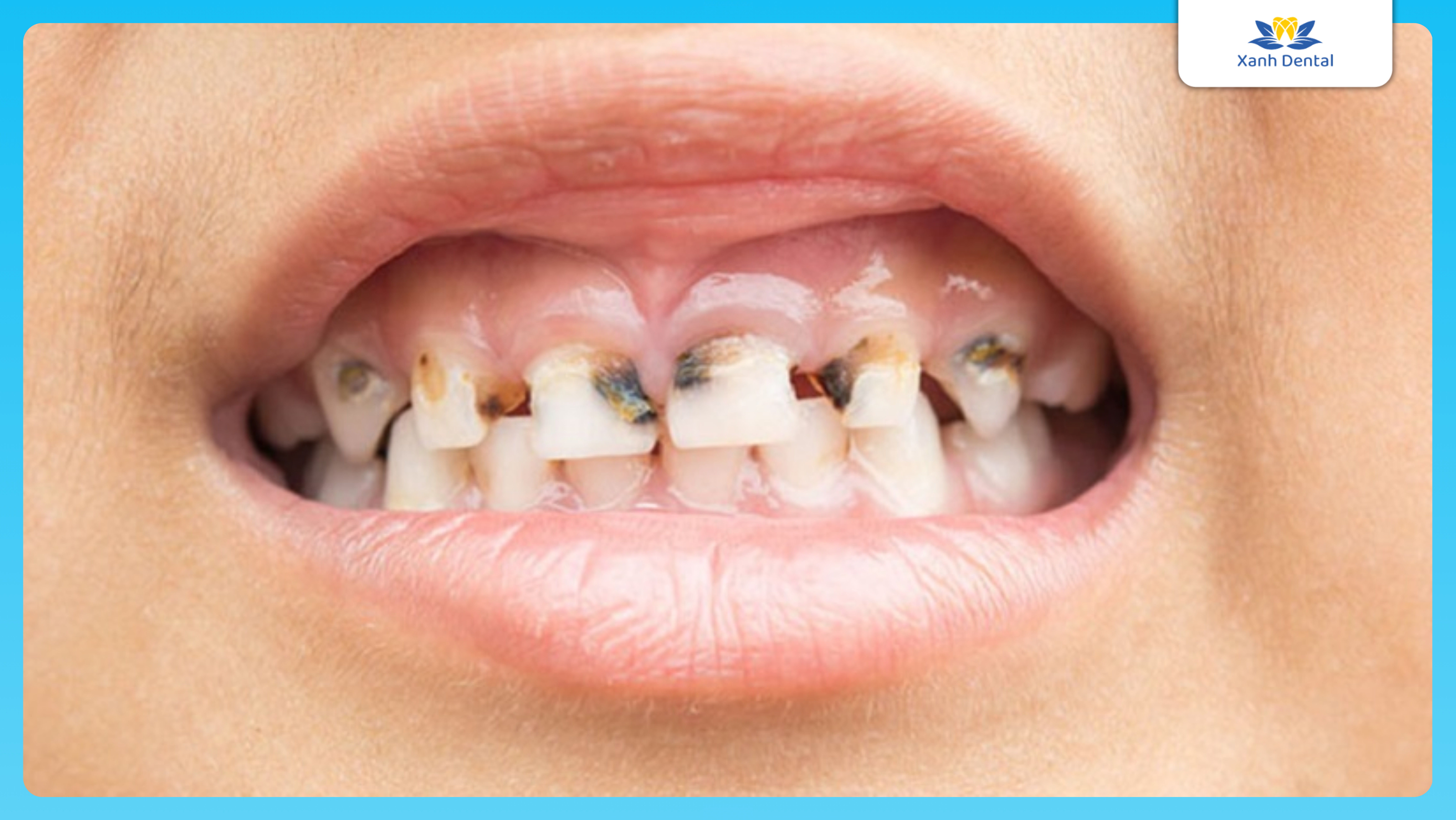 Răng sún ở trẻ! Những điều bạn nên biết